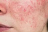 Hiểm họa khi tự ý lạm dụng thuốc, mỹ phẩm chứa corticoid
