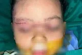 Bé 22 tháng tuổi bị chó cắn: Bác sĩ xử trí nhanh, hạn chế biến chứng