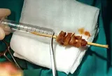 Bé 2 tuổi gặp sự cố nguy hiểm với que xiên thịt trong lúc chạy nhảy