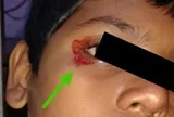 Bé trai 11 tuổi khóc ra máu khiến bác sĩ kinh ngạc