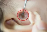 Bé 2 tuổi đau tai bất thường, bố mẹ "sốc" khi bác sĩ gắp ra thứ "đáng sợ" bên trong