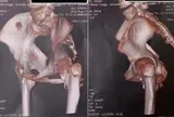 Lần theo dấu vết bất thường, bác sĩ phát hiện bệnh 'người hóa đá' hiếm gặp