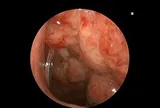 Tưởng chỉ viêm mũi họng thông thường, bệnh nhi 14 tuổi phát hiện ung thư di căn