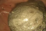 Bé gái 10 tuổi đau bụng suốt 3 năm, bố mẹ sốc khi bác sĩ lấy ra thứ "đáng sợ" trong bụng