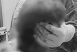 Bé gái 14 tuổi có vùng mông to bất thường, sự thật phía sau khiến gia đình "sốc ngang"
