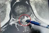 Ăn món khoái khẩu, người đàn ông 55 tuổi "rước" ấu trùng sán dây vào tủy sống suốt 12 năm mà không hay