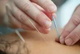 Đau chân dữ dội sau khi châm cứu, người phụ nữ sốc nặng khi biết sự thật đáng sợ