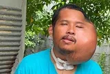 Xỉa răng sai cách, người đàn ông 31 tuổi có khuôn mặt "đáng sợ"