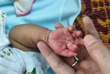 Xuất hiện dấu hiệu lạ ở da, bé 2 tháng tuổi mắc bệnh ít ai ngờ