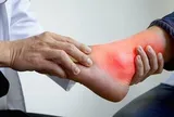 Chủ quan với đau khớp chân, thanh niên 20 tuổi ngỡ ngàng khi phát hiện mắc gout