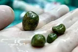 Cô gái 28 tuổi "sốc" khi bác sĩ gắp ra thứ "nổi da gà" trong bụng mình