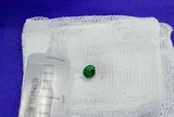 Tự lấy dị vật trong tai theo cách này, bé trai 9 tuổi suýt hỏng tai