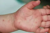 Tp.HCM ghi nhận số ca tay chân miệng tăng 47% trong một tuần