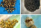 Bác sĩ bất ngờ khi gắp 49 viên sỏi trong túi mật người phụ nữ