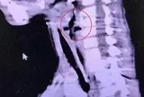 Bé trai 6 tuổi khò khè suốt nhiều tháng, bác sĩ gắp ra thứ "đáng sợ"