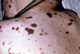 Não mô cầu có thể gây tử vong trong 24 giờ, bác sĩ chỉ triệu chứng cần cảnh giác