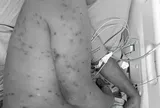 Bị hơn 300 con ong đốt, người đàn ông 62 tuổi nguy kịch