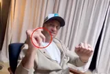 Ngón tay Martinez biến dạng vĩnh viễn