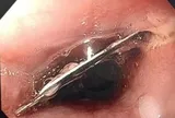 Ăn mì tôm thấy đau họng, đến viện phát hiện lưỡi dao lam trong thực quản