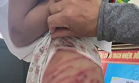 Hà Tĩnh: Xác minh vụ bé gái lớp 5 bị cha dượng bạo hành phải nhập viện