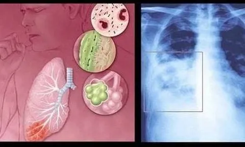 Chung tay phòng ngừa bệnh đường hô hấp do virus RSV gây ra