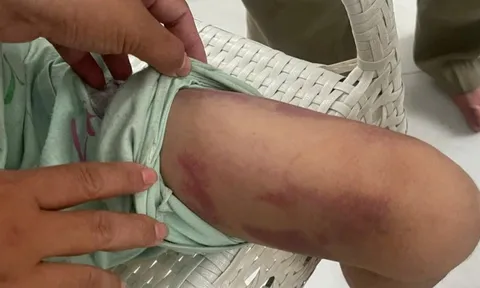 Vụ bé gái 9 tuổi bị bạo hành: Bắt tạm giam mẹ ruột và người tình