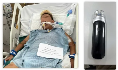 Suy thận, phổi tắc nghẽn vì hút thuốc lá điện tử từ năm 13 tuổi 0