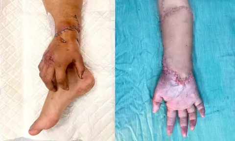 Bàn tay đứt lìa của mẹ bầu được nối lại sau thời gian 'nuôi' ở chân 1