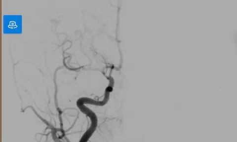 Cảnh báo đột quỵ não ở trẻ: Ca bệnh đánh thức sự chủ quan
