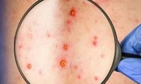 Đồng Nai ghi nhận ca mắc đậu mùa khỉ chưa rõ nguồn lây