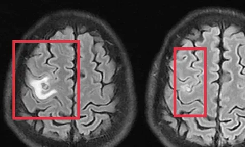 Người đàn ông 39 tuổi đau đầu, bác sĩ phát hiện thứ "đáng sợ" bên trong