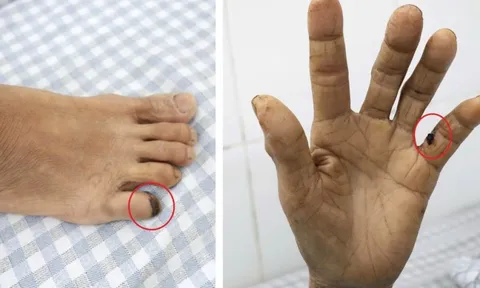 Vết xước do gà đạp khiến người phụ nữ 60 tuổi suýt mất mạng 1