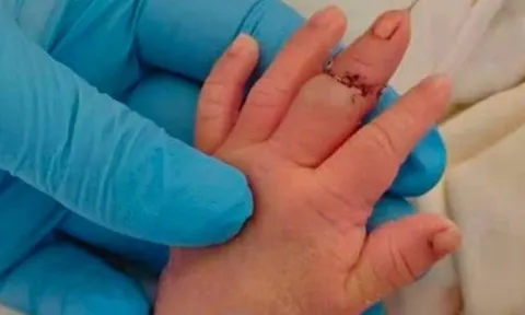 Nữ hộ sinh làm đứt ngón tay bé trai khi cắt dây rốn