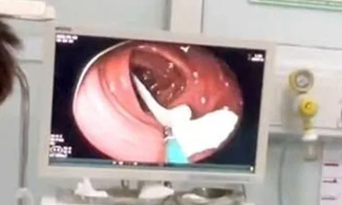 Người đàn ông 35 tuổi sốc nặng khi thấy ký sinh trùng "khổng lồ" đang sống trong ruột