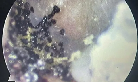 Nghe thấy âm thanh lạ trong tai, bé 7 tuổi đi khám thì sốc nặng