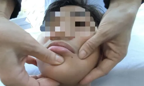 Liệt dây thần kinh số 7 do rét đậm 0