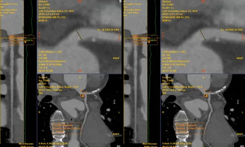 Chỉ đau tức ngực trái thoáng qua, không ngờ phát hiện bệnh lý tim mạch nguy hiểm 0
