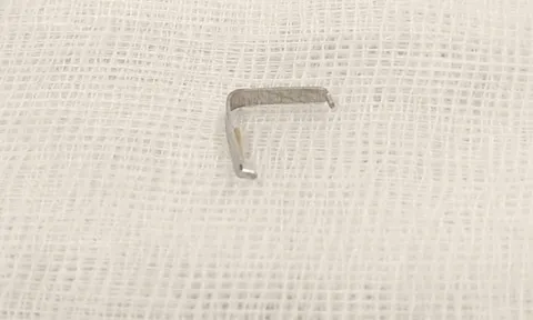 Tưởng con mọc răng, mẹ tá hỏa phát hiện vật sắc nhọn găm trong họng 0