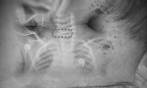 Bé trai bị sốt và co giật, bác sĩ phát hiện ra điều đáng sợ