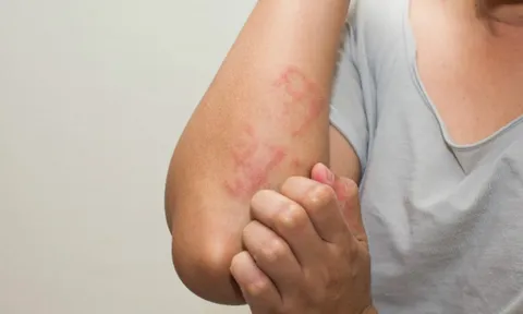 Ngứa không dứt, người phụ nữ 37 tuổi phát hiện cơ thể nhiễm tới 5 loại ký sinh trùng