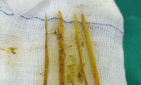 Cô gái 26 tuổi đau bụng dữ dội, bác sĩ “chết lặng” khi phát hiện thứ bên trong