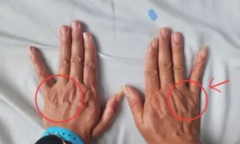 Tê ngón tay út tưởng chuyện nhỏ, người đàn ông suýt teo cả bàn tay 0