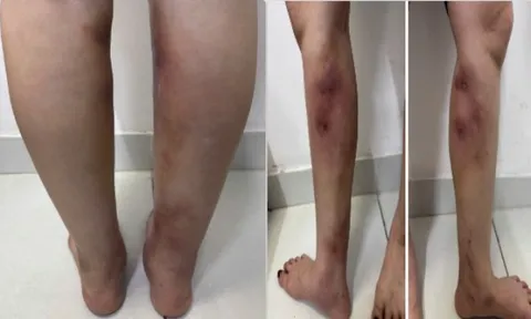 Chân biến dạng sau tiêm filler tại nhà