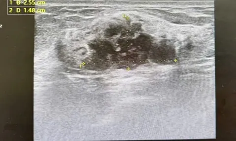 Phát hiện ung thư khi đi khám sức khoẻ định kỳ