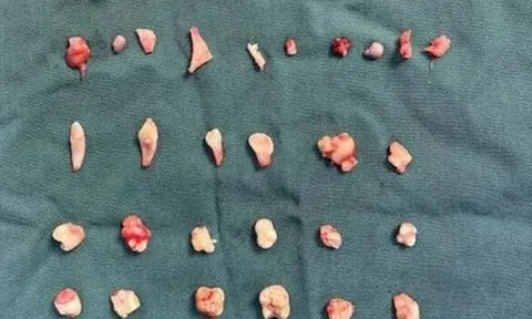 Cô gái đau bụng dữ dội, bác sĩ phát hiện ra bí mật bên trong