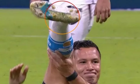 Cầu thủ Brazil bình thản dù cổ chân bị gãy