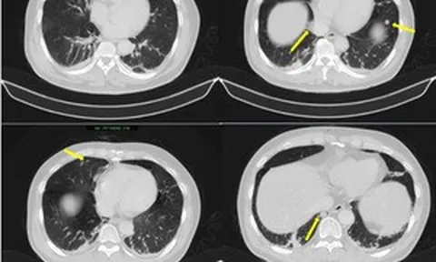 Người đàn ông phát hiện mắc hai bệnh ung thư cùng lúc