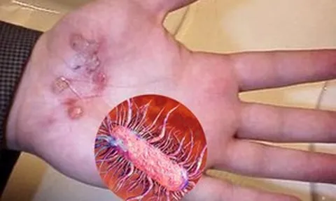 Suýt mất mạng do vi khuẩn 'ăn thịt người' tấn công