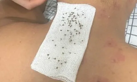 Hai bố ngất xỉu khi đi tìm tổ chim, đến viện bác sĩ chỉ ra nguyên nhân "đáng sợ"