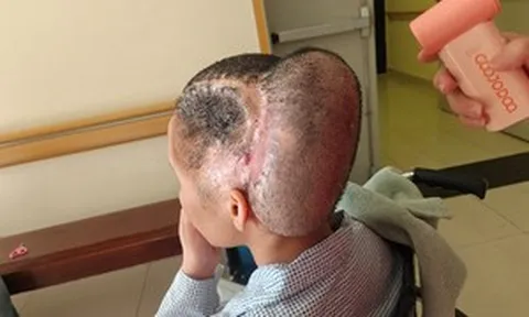 Đột quỵ sau hút mỡ làm đẹp